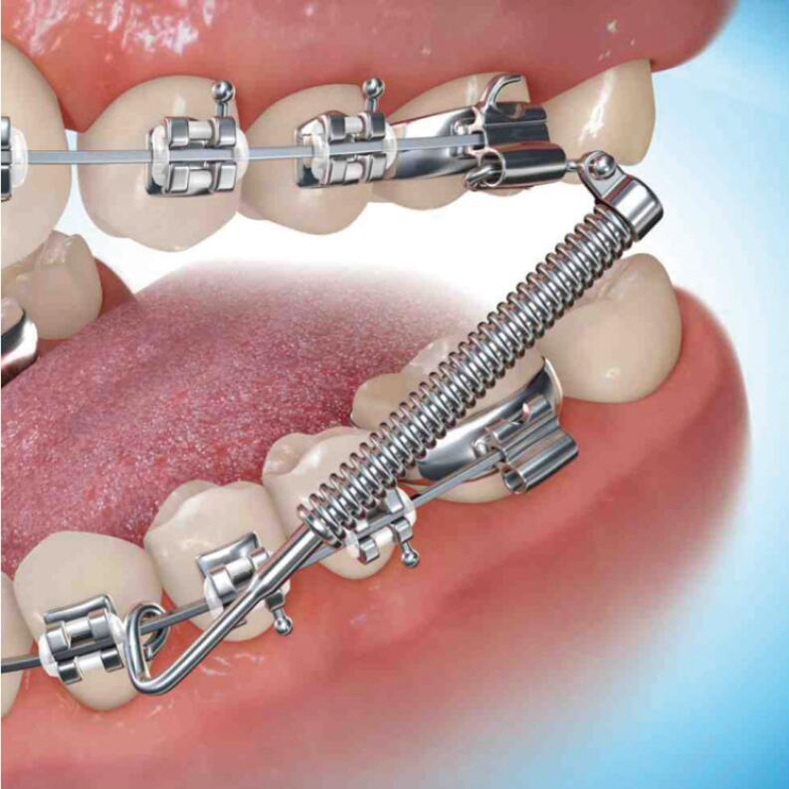 Forsus Appliance Orthodontic Fatigue Resistant Device Kit Class II Treatment 3M