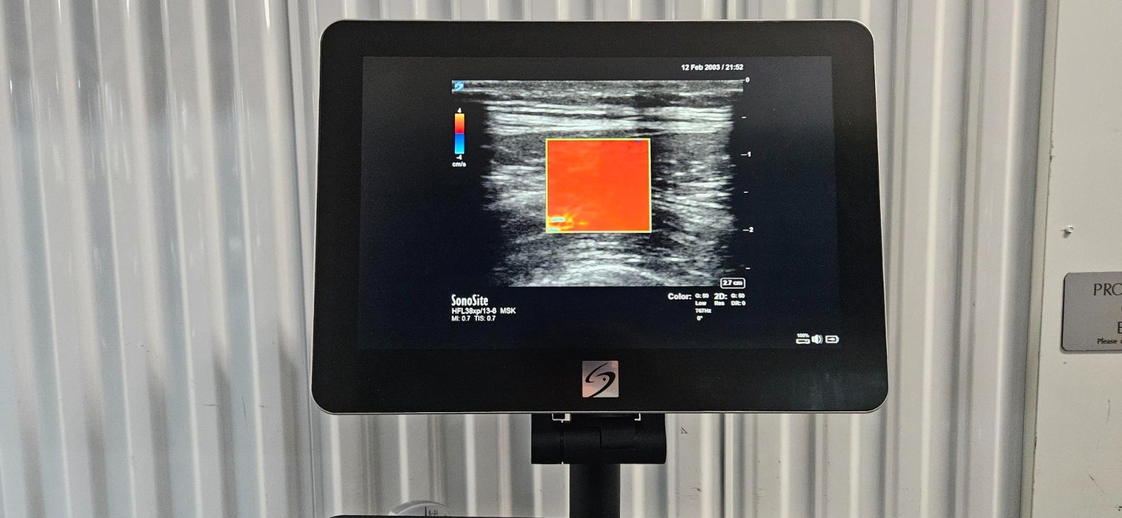 SonoSite X-Porte Ultrasound