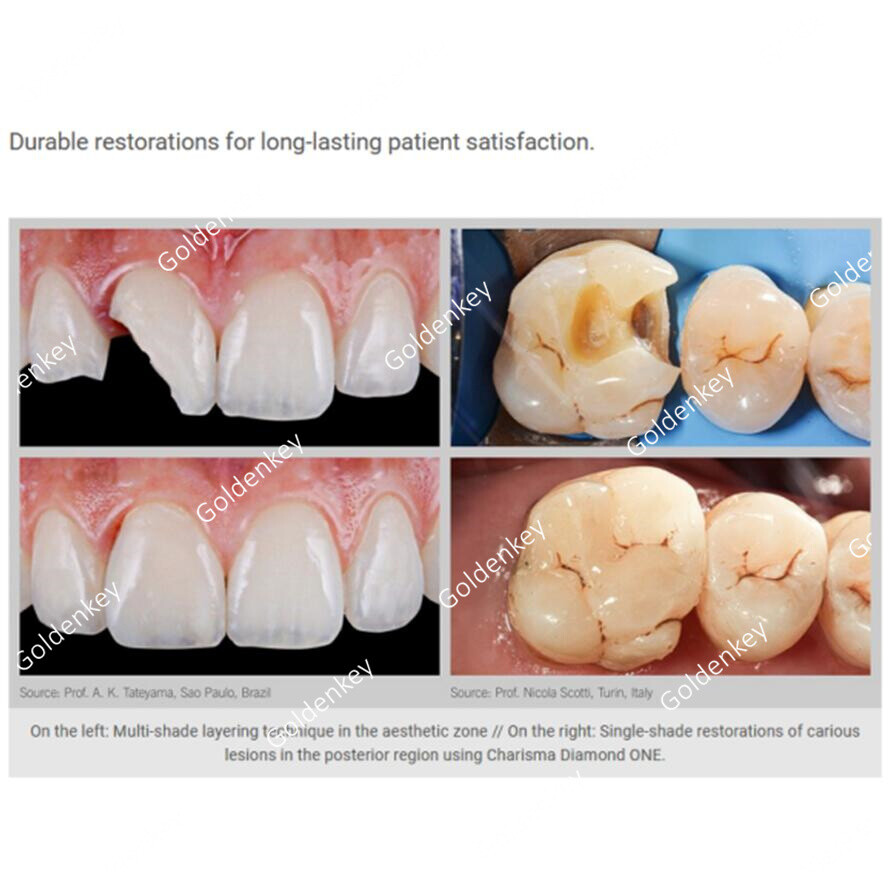 CHARISMA Dental Composite Syringe Light Cure Resin Tooth Filling Material 1Box