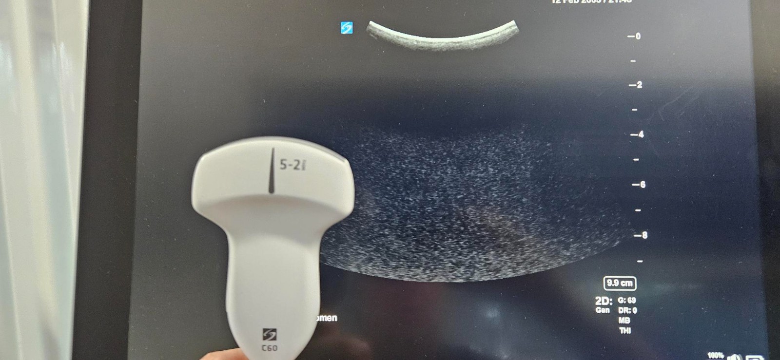SonoSite X-Porte Ultrasound