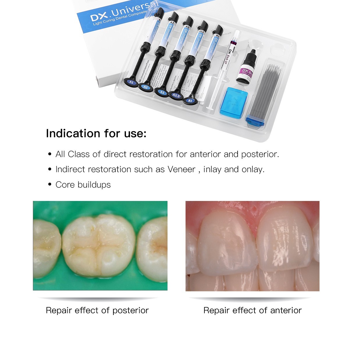 DENTEX Dental Light Cure Composite Resin Syringe Kit Shade A1 A2 A3 A3.5 B1