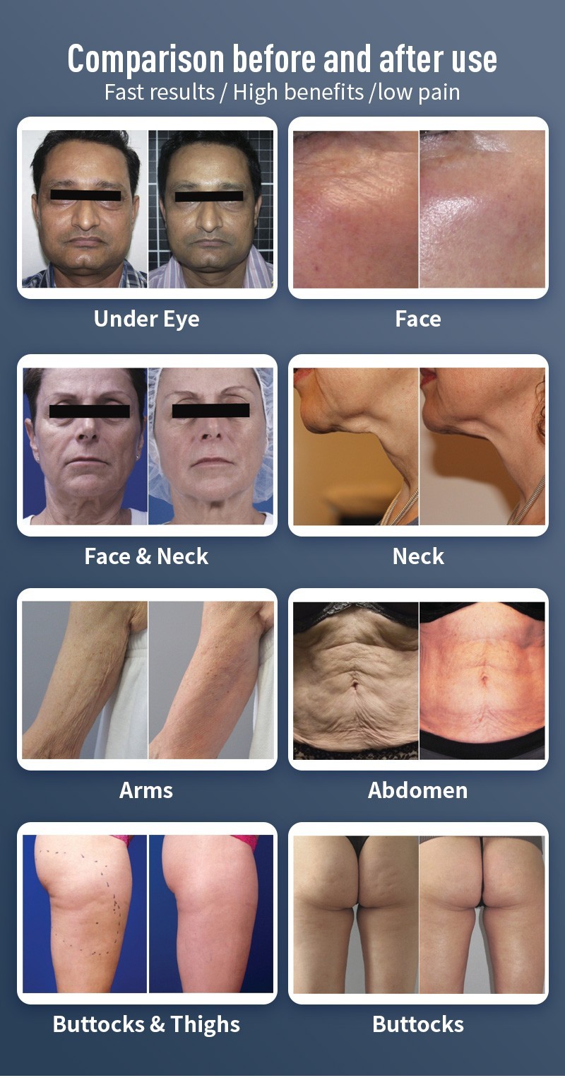 Venus Concept Venus Legacy Radiofrequency Cart-Mounted Skin Tightening