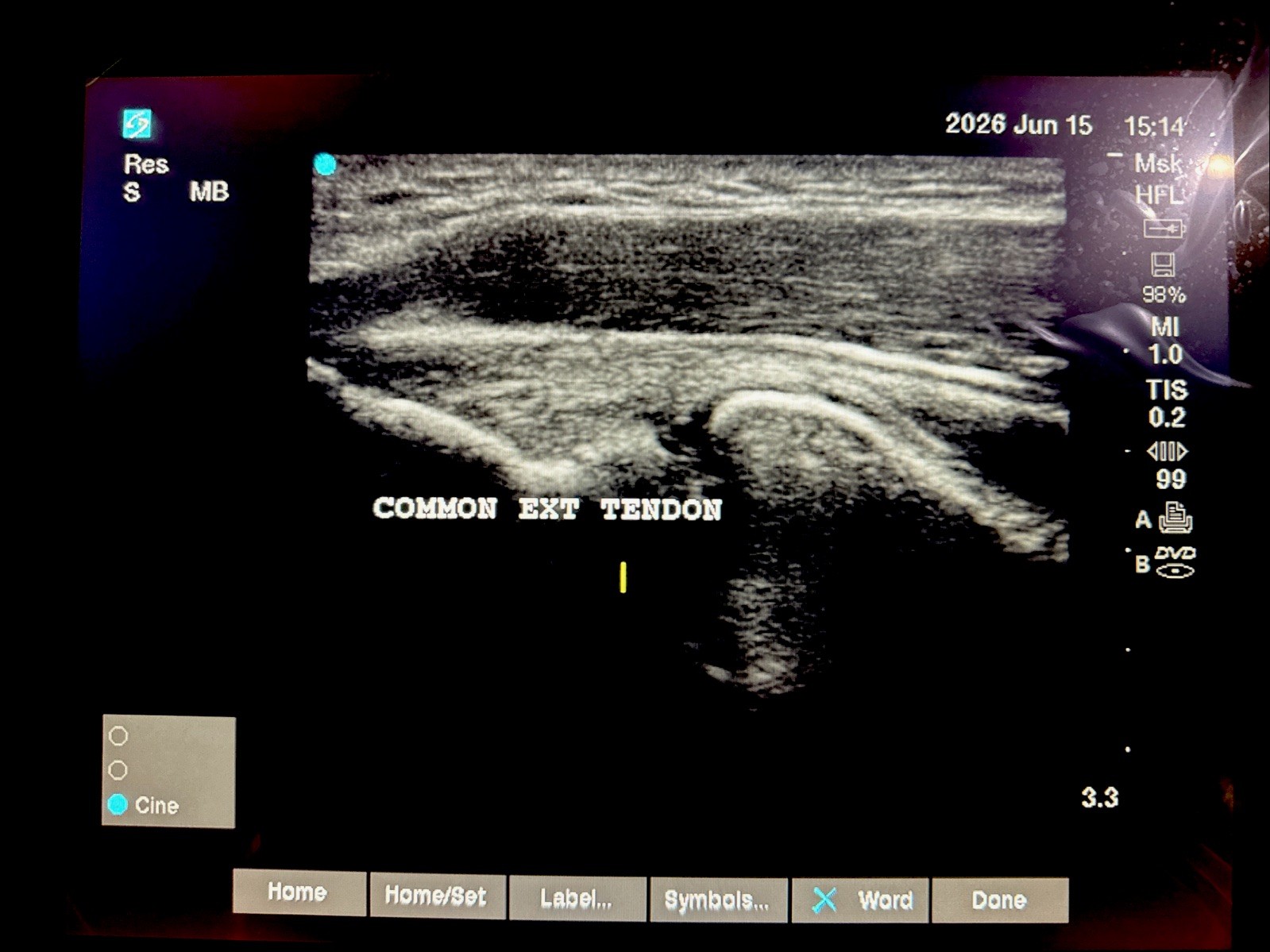 SonoSite Edge II Ultrasound | Factory Refurb | Probe Choice I 1-Year Warranty