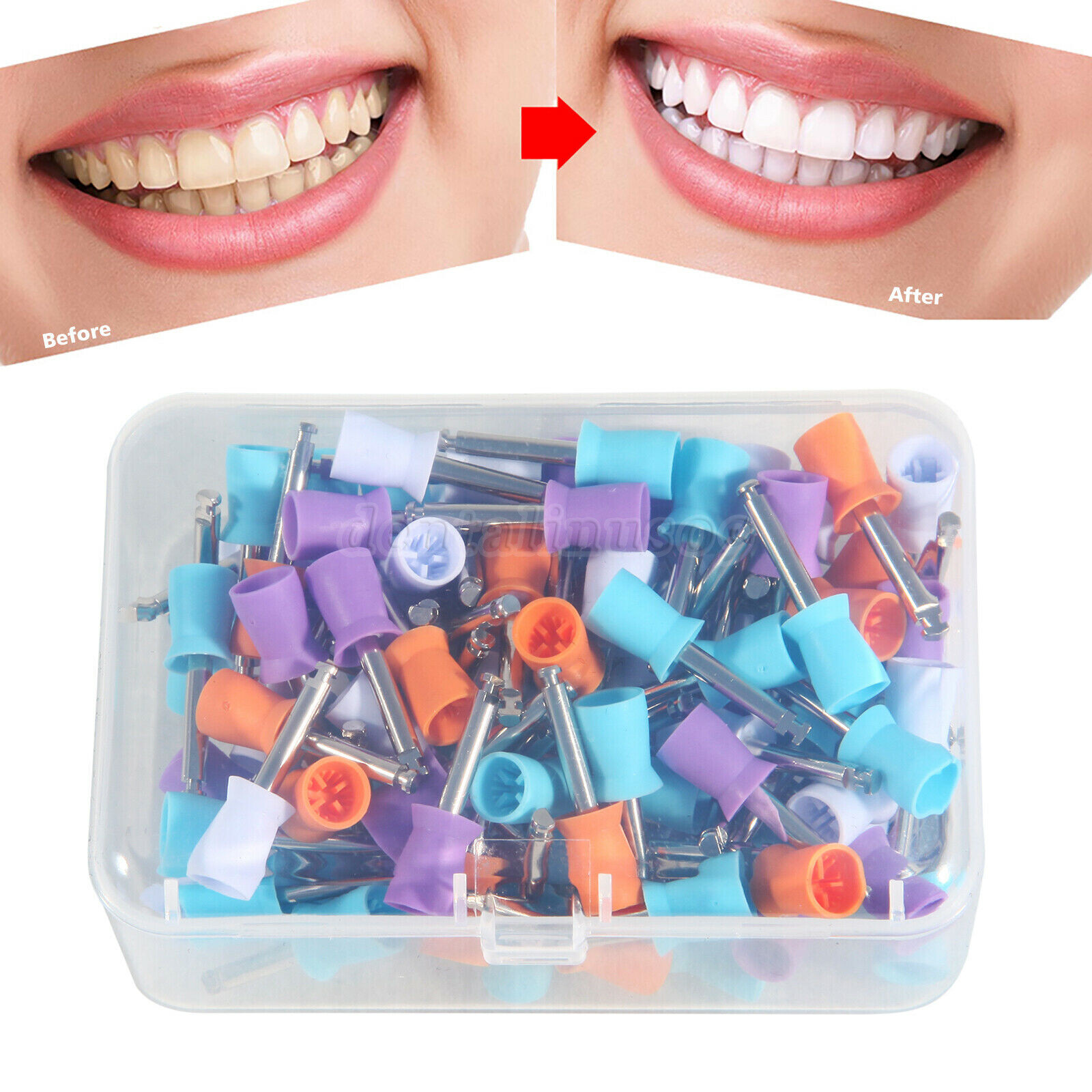 100PCS Mixed Colors Dental Prophy Tooth Polishing Cups Latch Type Rubber SA
