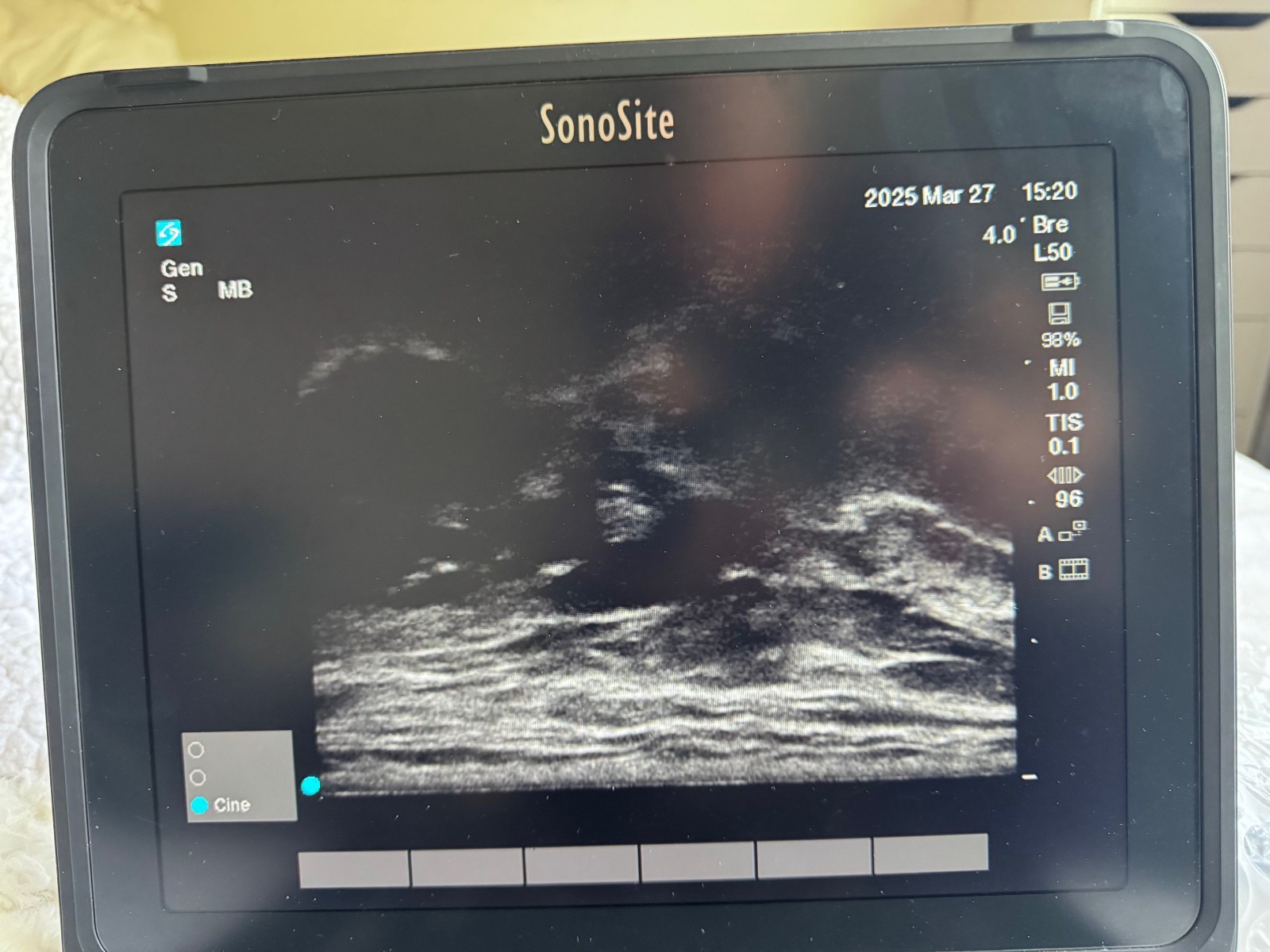 Sonosite Edge II 2017 HFL50x/15-6 MHz transducer
