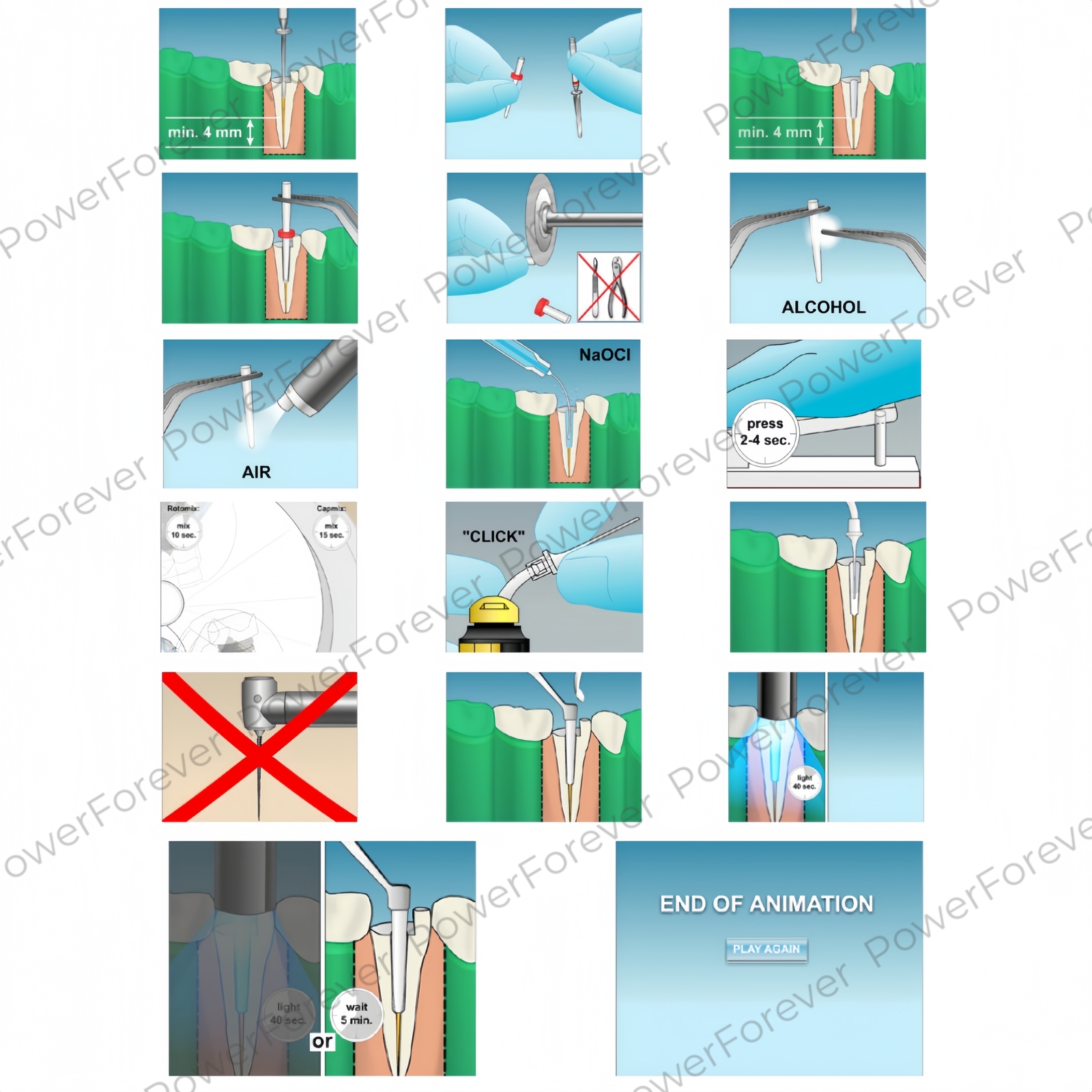 Dental Glass Fiber Post Endo Drill Root Canal Posts Fits 3M 3D ESPE RelyX