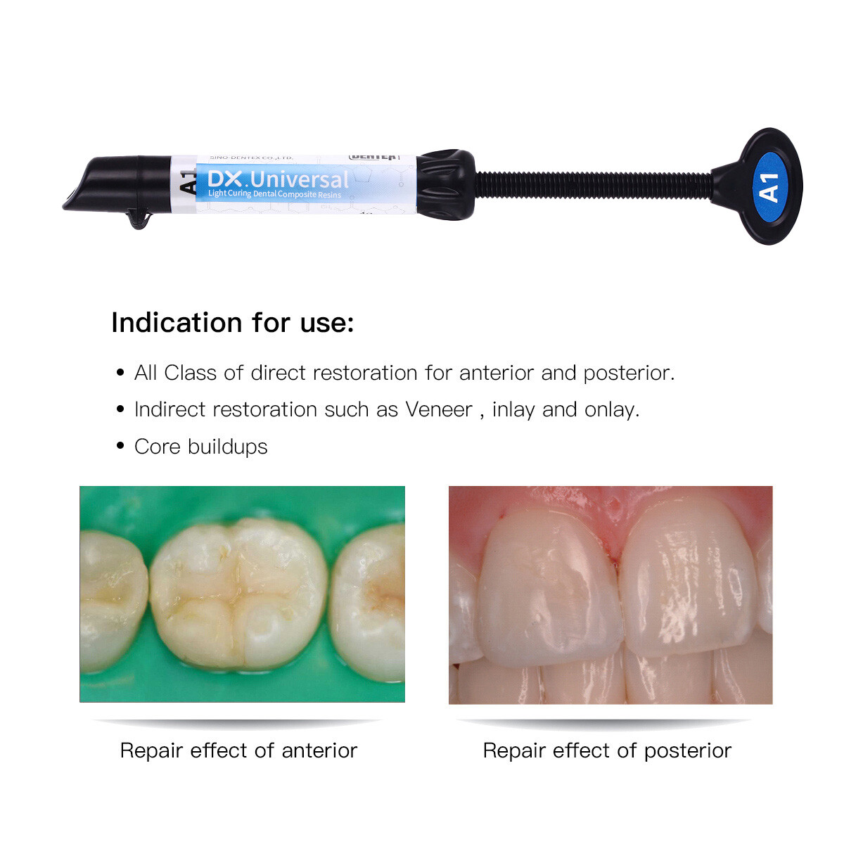 DX Dental Syringe Ultra Universal Curing Light Composite Resin A1 A2 A3 A3.5 B1