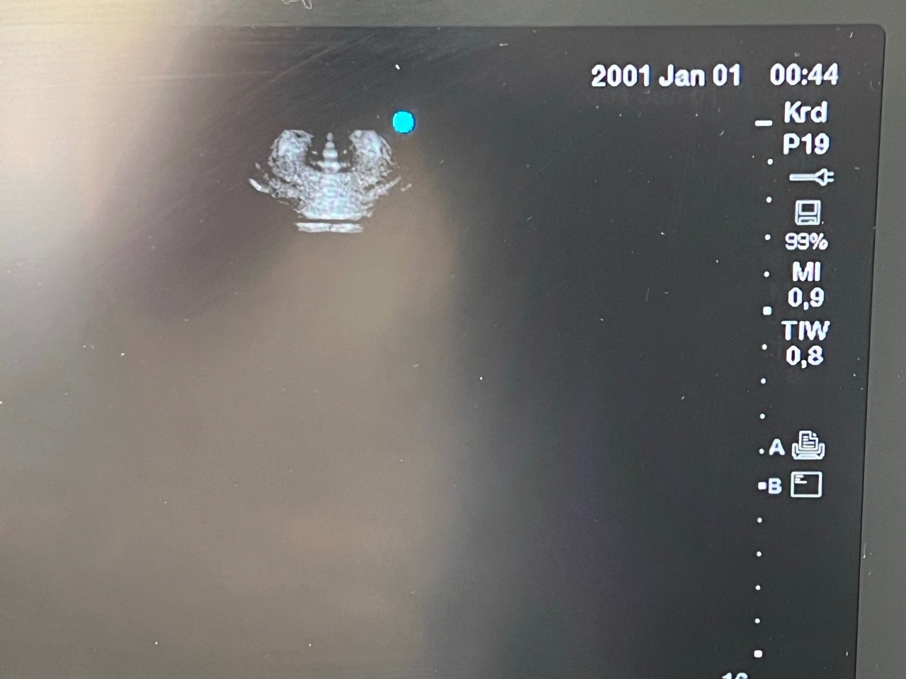Ultrasound SonoSite Edge II 2017/09 + rP19x, rC60xi, HFL 38xi Transducer(#2335)