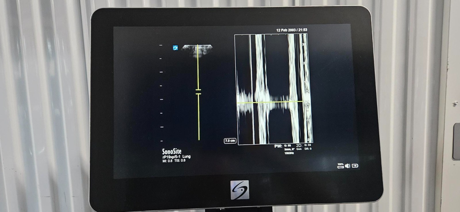 SonoSite X-Porte Ultrasound