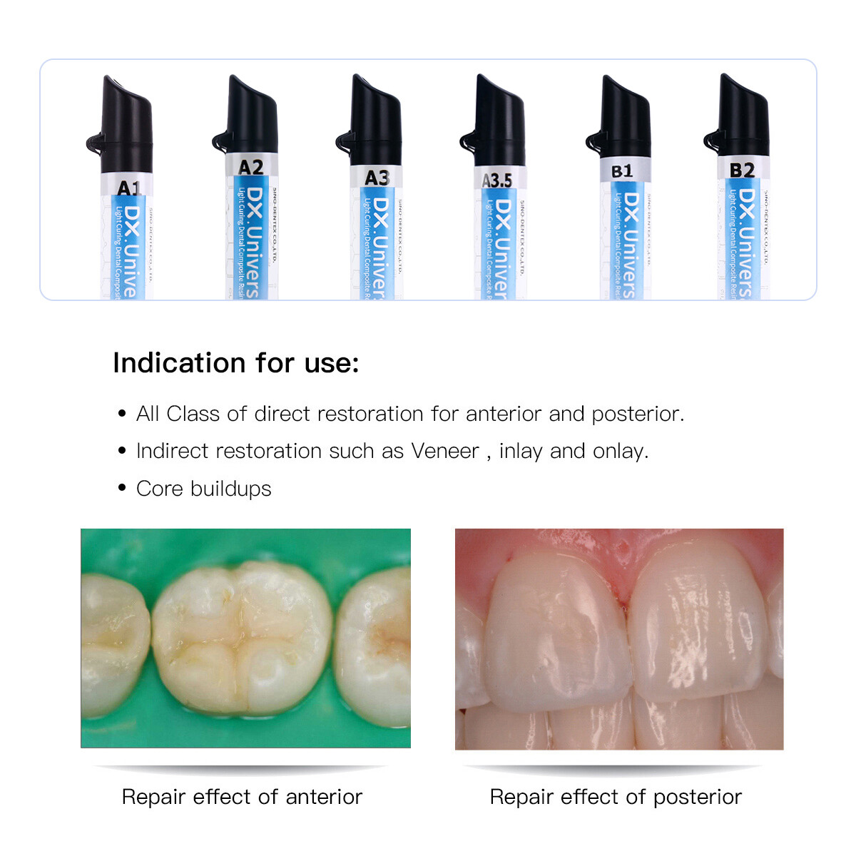 Dental Universal Light Cure Composite Veneer Teeth Resin SyringeA1 A2 A3 A3.5 B1